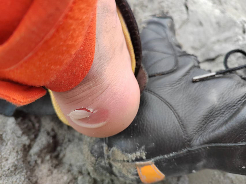 長(zhǎng)途的救援跋涉，消防員腳后跟磨壞。四川省森林消防總隊(duì)供圖