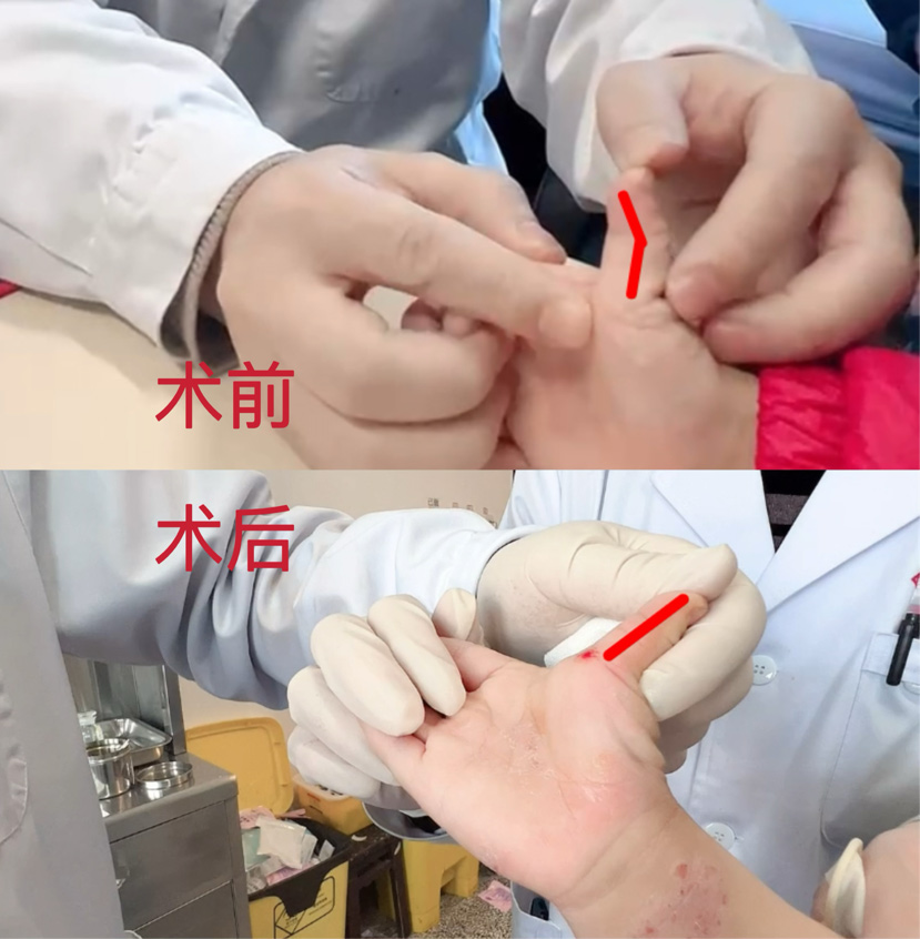 治療前后患者情況對比。四川省骨科醫(yī)院供圖